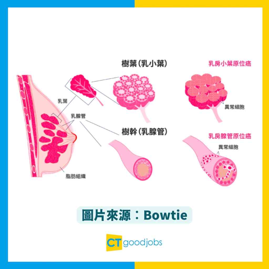 【甚麼是原位癌？】原位癌成因是甚麼？一文睇清常見原位癌種類、良性腫瘤VS惡性腫瘤分別及治療方法